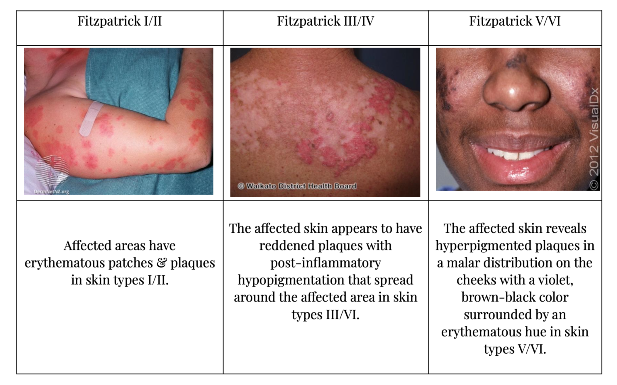 Seborrheic Dermatitis  Symptoms & Treatment - Skinsight